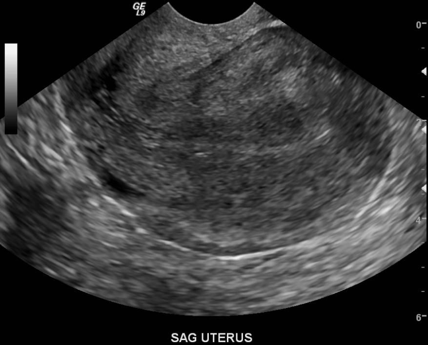 File:Retroverted uterus US 001.jpg