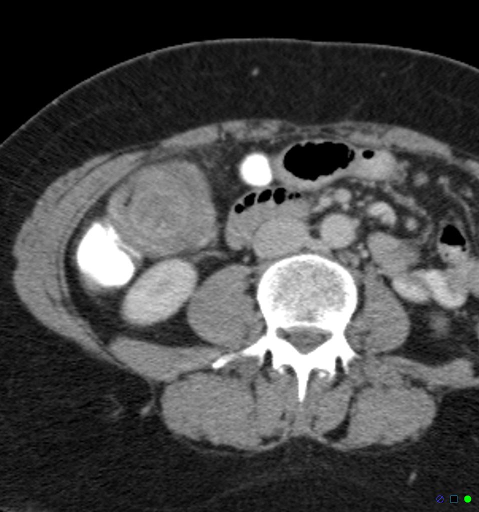 File:Ascending-colo-colic-intussusception-due-to-lipoma.jpg