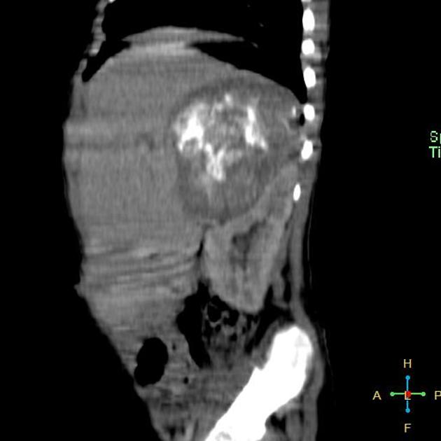 Neuroblastoma observed as a right suprarenal mass with an abundant calcification on sagittal CT scan[2]