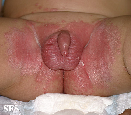 File:Diaper dermatitis02.jpg