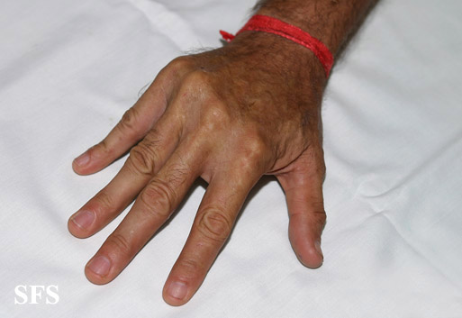 Dupuytren contracture. Adapted from Dermatology Atlas.
