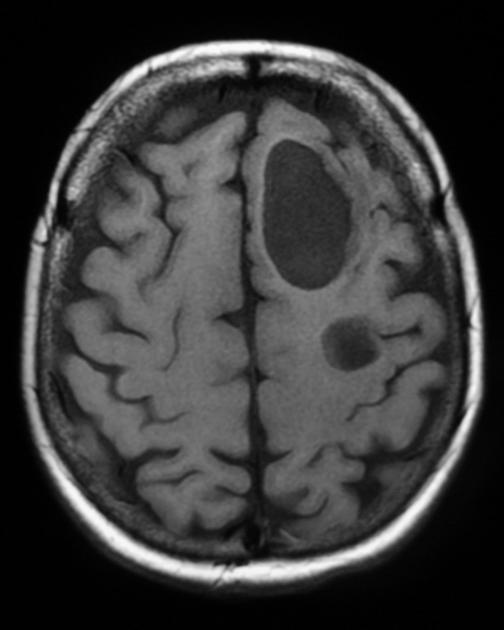 Axial T1 MRI scan of an elderly patient with history of small cell lung cancer, presenting with increasing headaches, demonstrates multiple cystic cerebral metastases.[5]