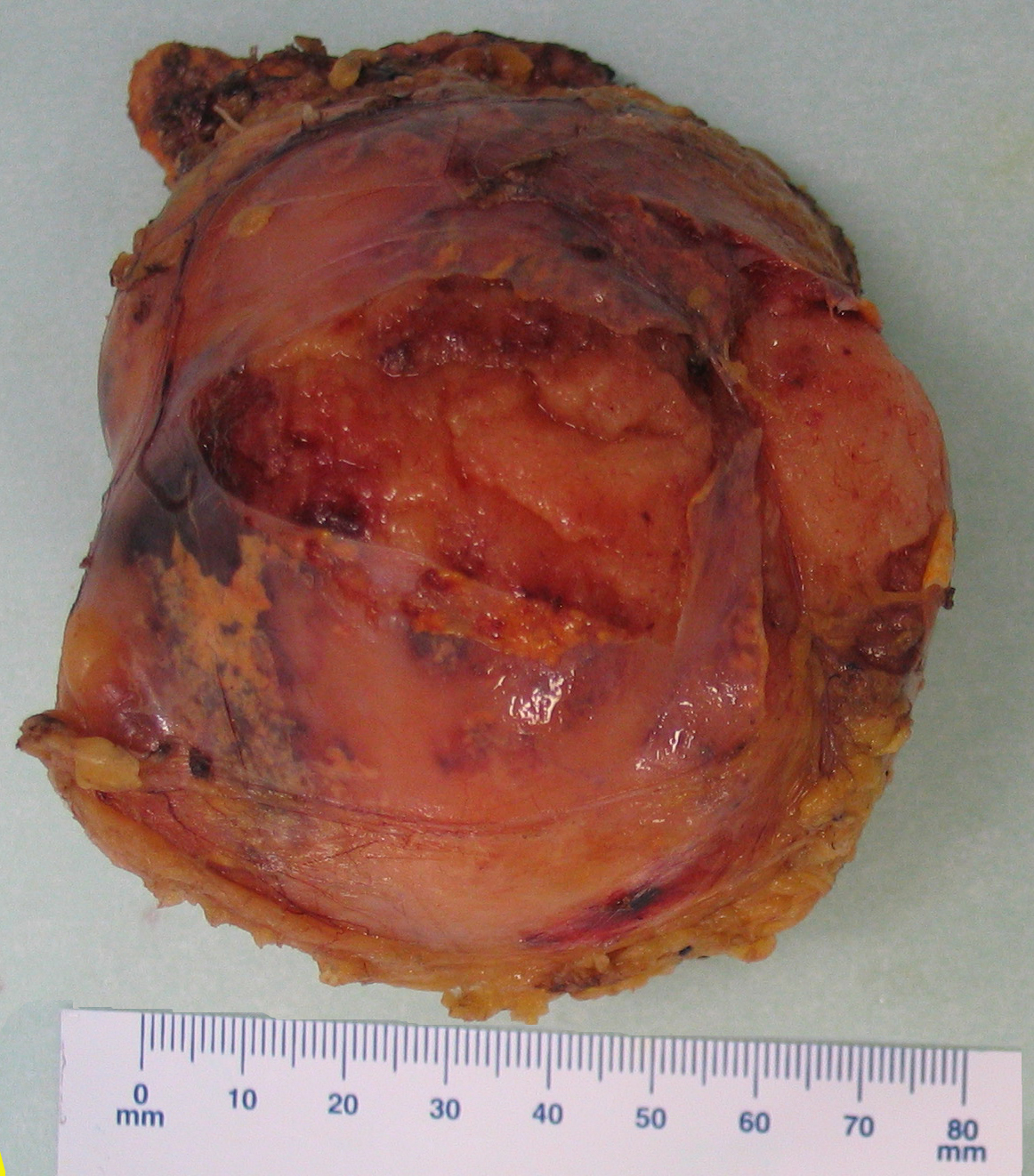 Myelolipoma gross pathology,source: By Mattopaedia - Own work, CC BY-SA 3.0, https://commons.wikimedia.org/w/index.php?curid=5668284