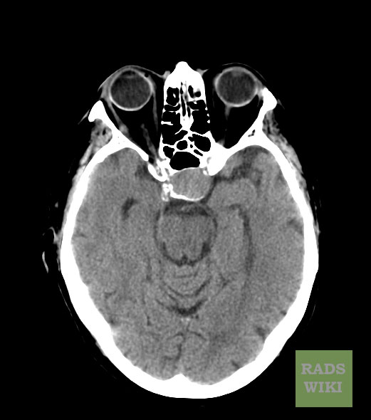 File:Pituitary-macroadenoma-CT-01.jpg