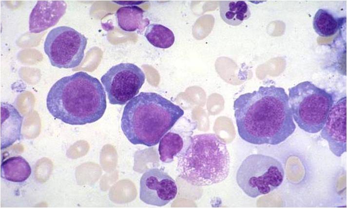 Bone marrow in megaloblastic anemia