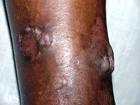 keratoacanthoma. Adapted from Dermatology Atlas.[1]