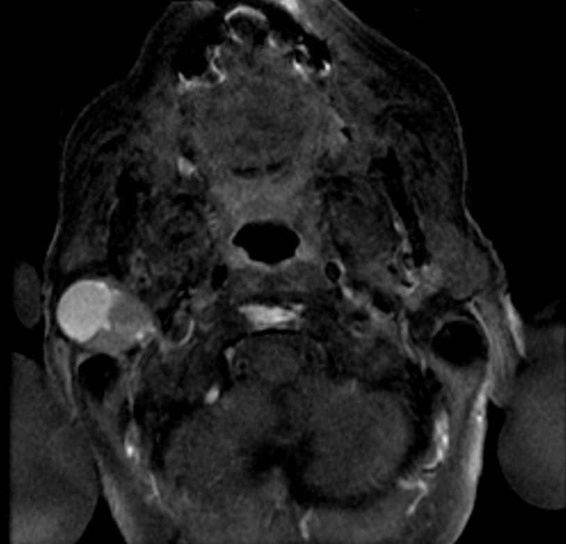 File:Pleomorphic adenoma MRI 104.jpg