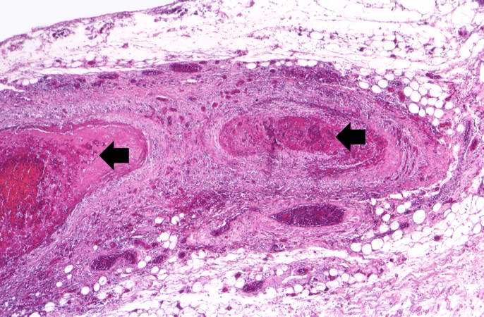 This is a higher-power photomicrograph of this mesenteric vessel. Note the thrombotic material occluding the vessel (arrows) and the inflammatory cell infiltrate in the wall of the vessel and in the surrounding adventitia.