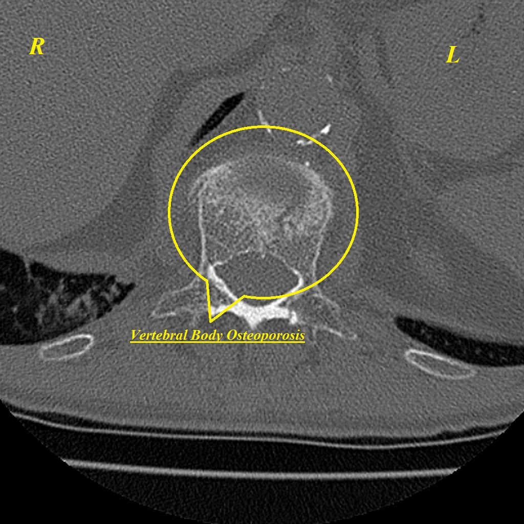 Pathological fracture in T12 and L1 (axial view) - Case courtesy of Dr Roberto Schubert, Via: Radiopaedia.org[7]