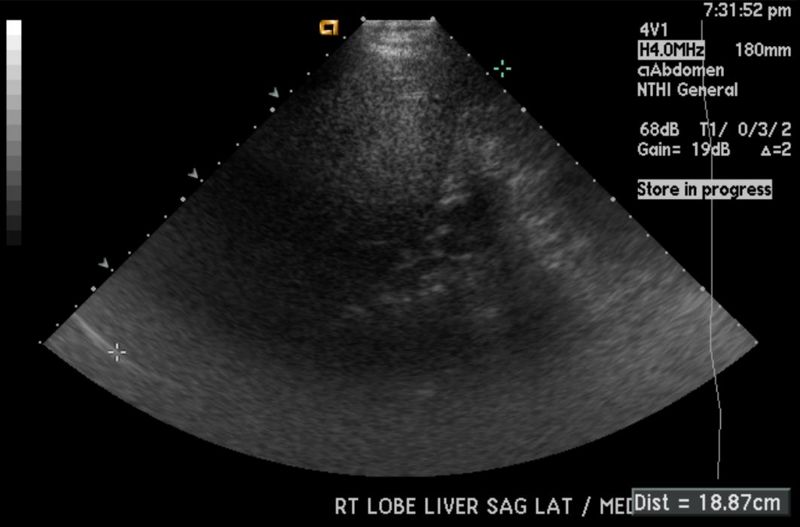 File:Fatty infiltration of liver ultrasound 002.jpg