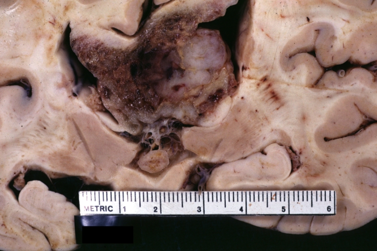 Brain: Glioblastoma Multiforme: Gross fixed tissue close-up large necrotic tumor mass in septum pellucidum