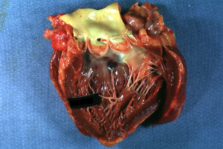 HEART: Hemorrhage In Region of Left Bundle Branches: Gross natural color of opened left ventricular outflow tract with subendocardial hemorrhage just below membranous septum. A case of Hodgkins disease with probable sepsis