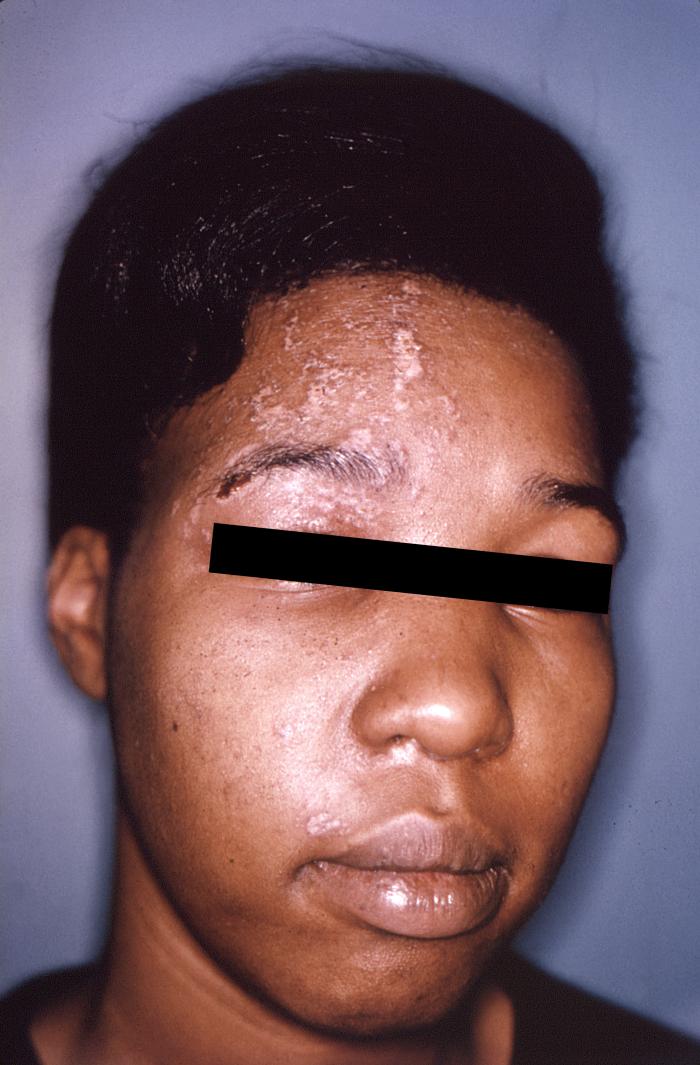 The pustulo-vesicular rash on this African-American woman’s face, represents a herpes outbreak due to the Varicella zoster virus (VZV) pathogen, which may lay dormant in the spinal nerve roots through a chickenpox infected individual’s life, only manifesting its presence through outbreaks, as Shingles, or herpes zoster. It is caused by the Herpesviridae chickenpoxvirus.
