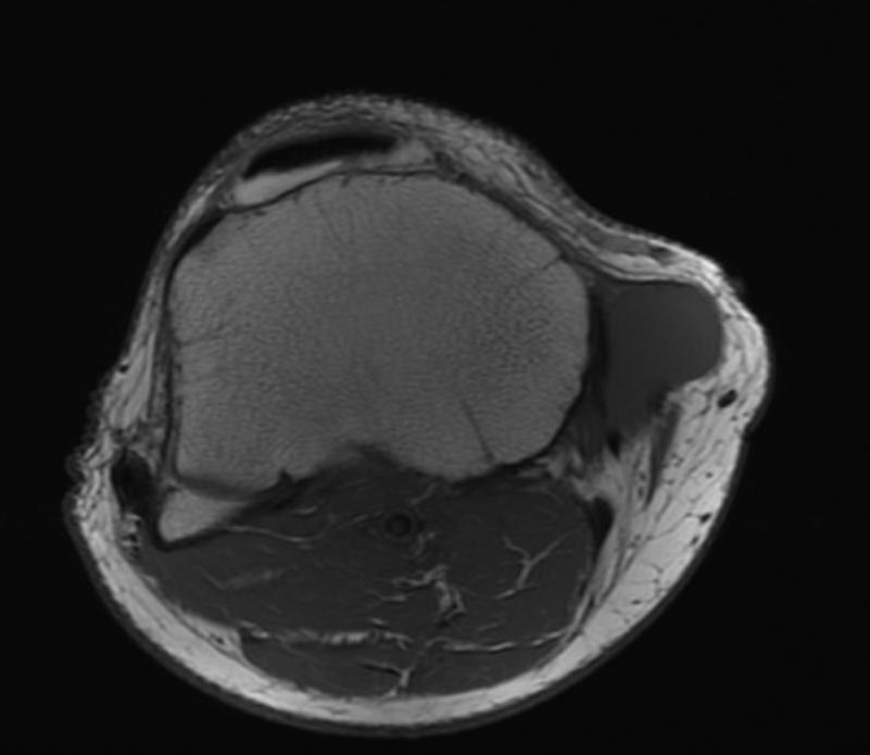 File:Parameniscal cyst MRI 004.jpg