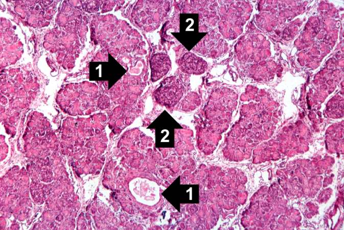 This higher-power photomicrograph of the pancreas shows interstitial tissue and the presence of small cystic spaces (1) within the acinar lobules. These spaces are filled with an eosinophilic proteinaceous material. The islets of Langerhans (2) are unaffected.