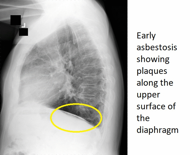 Occupational lung disease x ray - wikidoc