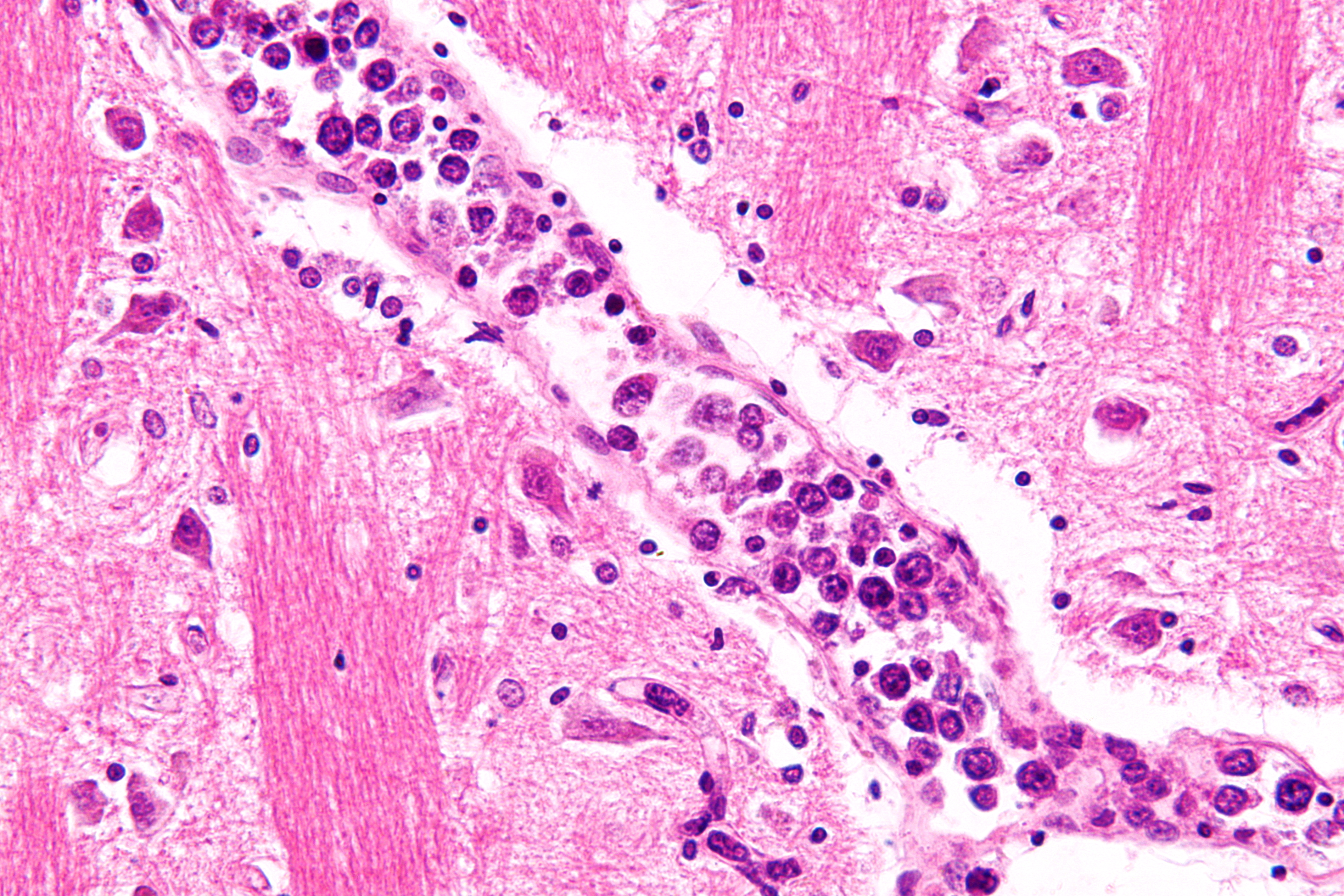 File:Intravascular lymphoma - very high mag.jpg