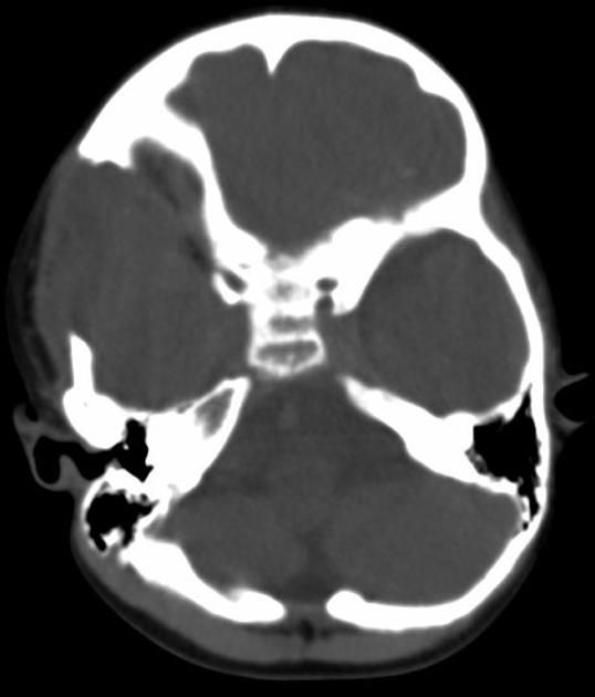 Head CT scan illustrating multiple osteolytic lesions of Langerhans cell histiocytosis