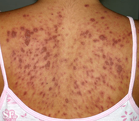 Lupus erythematosus-systemic. Adapted from Dermatology Atlas.[1]