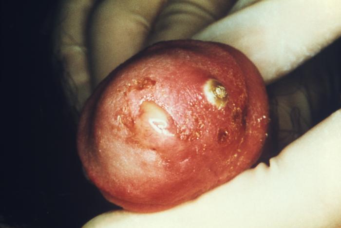 This male presented with purulent penile discharge due to gonorrhea with an overlying penile pyodermal lesion.Pyoderma involves the formation of a purulent skin lesion as in this case located on the glans penis, and overlying the sexually transmitted disease gonorrhea. Adapted from CDC