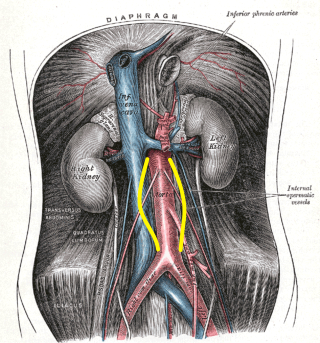 A plate from Gray's Anatomy with yellow lines depicting the most common infrarenal location of the AAA.