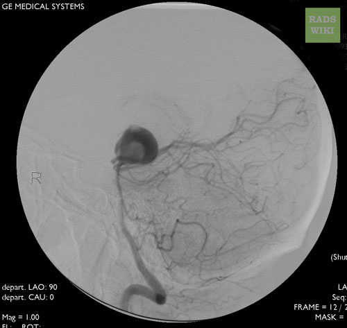 Angiography: A large basilar artery aneurysm