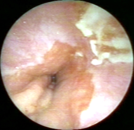 Caustic lye esophagitis