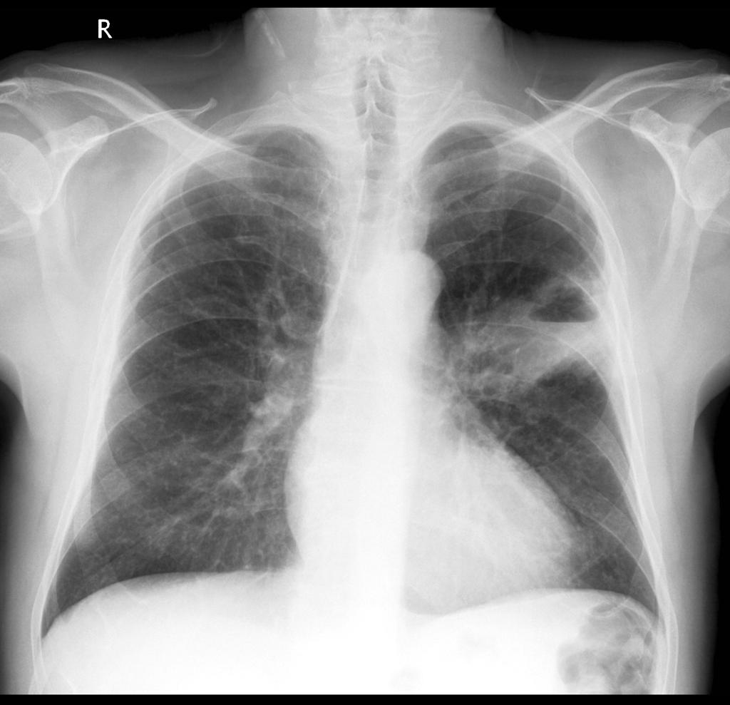 Squamous cell lung cancer: lung cavitating mass left upper lobe adjacent to the oblique fissure. The prominent air-fluid level is best seen on the lateral radiograph