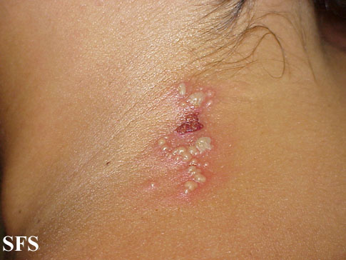 File:Herpes simplex 15.jpeg