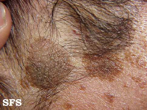 a seborrhea s a pikkelysmr kezelsre kiütések vörös foltok formájában a kezeken és a lábakon