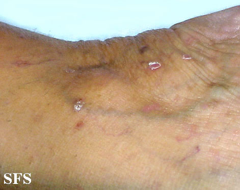 Lichen planus vesicular. Adapted from Dermatology Atlas.[1]