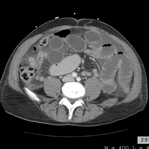 Small bowel obstruction Image courtesy of RadsWiki and copylefted