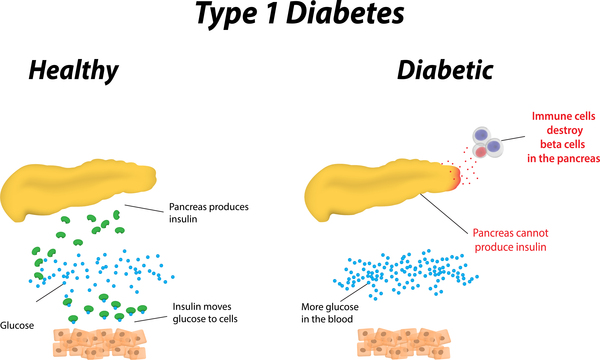 Type-1-diabetes pathophysiology