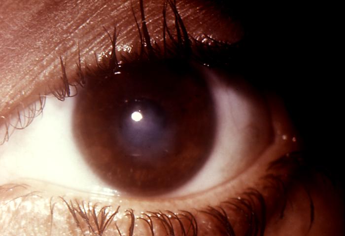 Note the cloudiness of this patient's right eye in this case of gonococcal conjunctivitis due to N. gonorrhoeae bacteria. Gonococcal conjunctivitis in caused by a direct inoculation of the conjunctival membrane of the eye with Neisseria gonorrhoeae bacteria, causing this membrane covering the eye to become inflamed, edematous, and produce a purulent exudate.Adapted from CDC