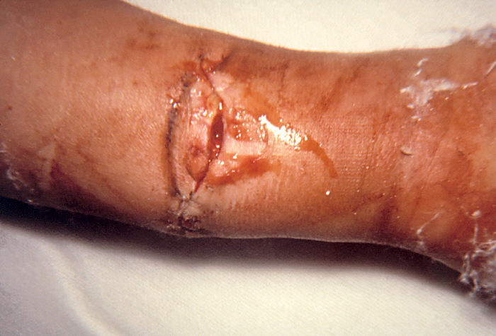 File:Botulism wound.jpg