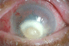 Exogenous fungal endophthalmitis with corneal ulcer