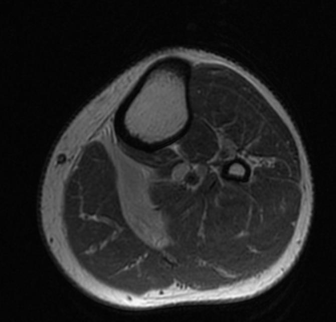 File:Plantaris rupture MRI 002.jpg