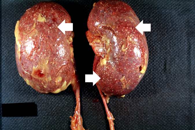 This autopsy photograph of the kidneys demonstrates the multifocal punctate lesions visible on the serosal surface (arrows). Don't confuse these small yellow punctate lesions with the fat that is adherent to the renal capsule.