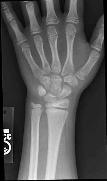 Salter-Harris fracture-IImage courtesy of RadsWiki and copylefted