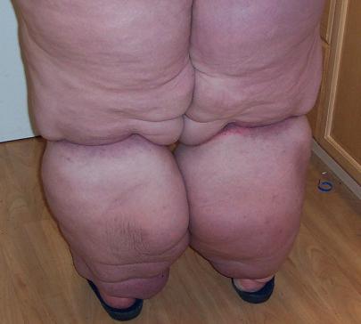 Stage 3 lymphedema back view before treatments
