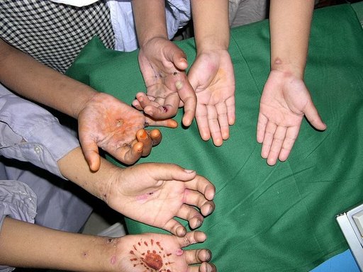 File:Scabies (common location is ventral wrist).jpg