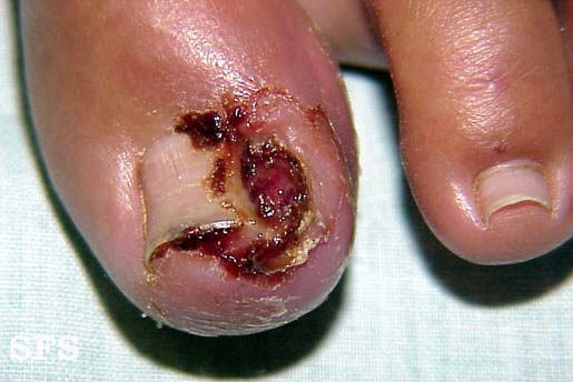 Ingrowing nail. Adapted from Dermatology Atlas.[1]