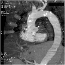 File:Renal artery stenosis 044.jpg