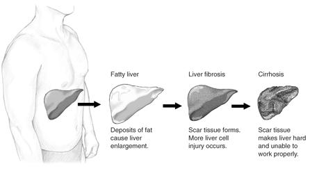 Different stages of liver damage