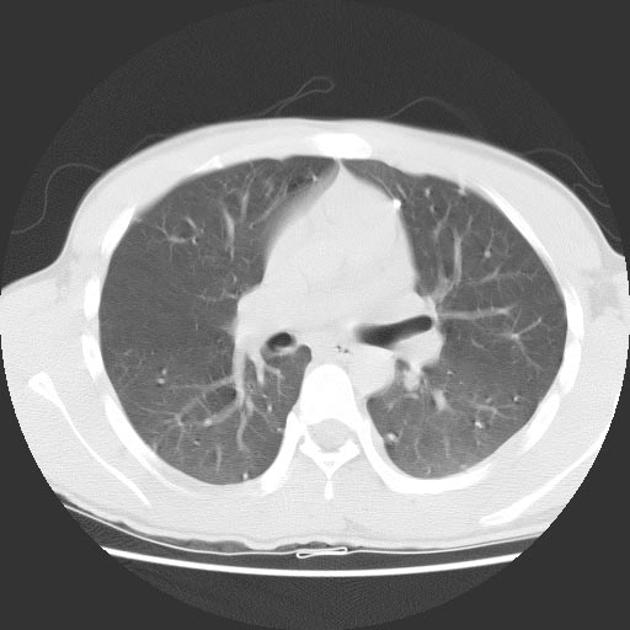 File:Varicella Pneumonia CT - 3.jpg