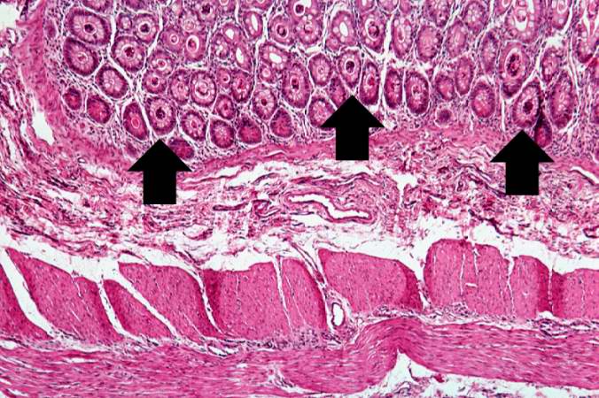 A higher-power photomicrograph shows the bottom of the intestinal crypts and the other normal layers of the intestine. Even at this magnification, accumulations of eosinophilic debris can be seen in many of the intestinal crypts (arrows).
