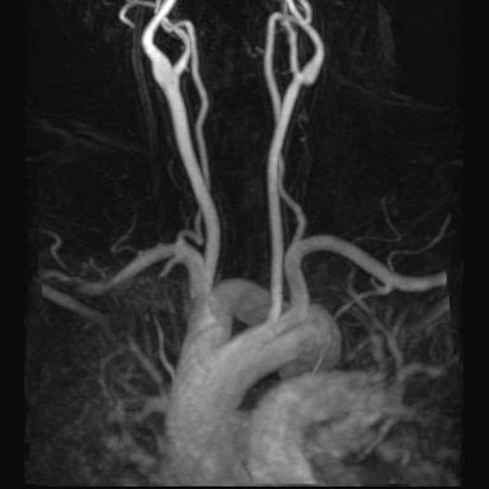 Demonstration of a double aortic arch
