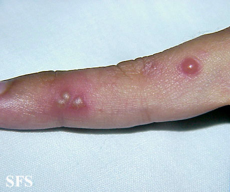 File:Herpes simplex 28.jpeg