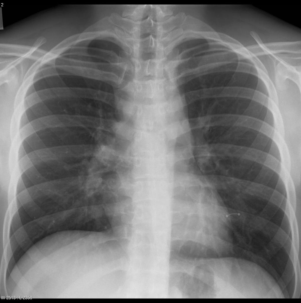 Chest x-ray demonstrates widening of the mediastinal outlines and widening of the right para tracheal stripe. Lateral projection confirms predominantly anterior mediastinal mass. [3]