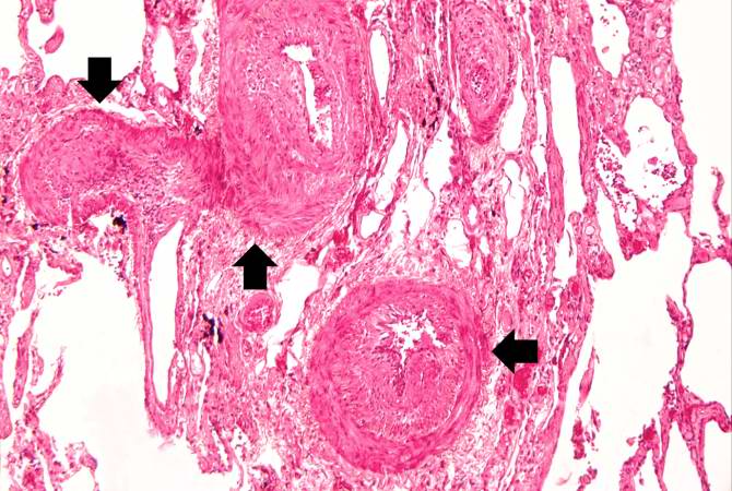 This medium-power photomicrograph shows fibrosis and severe intimal changes in blood vessels (arrows).